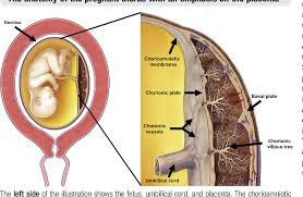 Image result for Chorioamnionitis