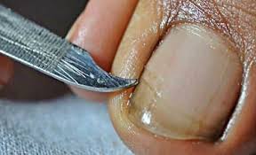 remove keratin or debris under the toenail