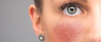 24 hrs and the redness was gone. Rosacea Steer Clear Of These Foods For Calm Skin Joyous Health