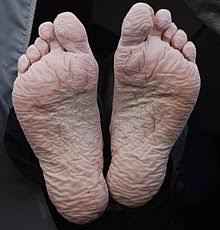 It is the terminal portion of a limb which bears weight and allows locomotion. Trench Foot Wikipedia