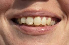 Patients of diabetes are the most likely to show white substances forming in their mouths. What Causes White Spots On Teeth Cosmetic Dentistry Services Ar