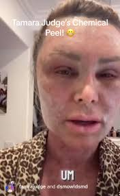 What Happened to Tamara Judge Teeth