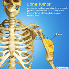 In most primary bone sarcomas, there are 5 stages: Bone Tumor Types Symptoms Treatment Survival Period