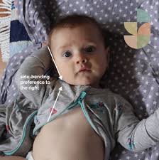 Flat Head Syndrome: When to Worry & What to Do