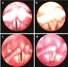 Image result for Functional Aphonia