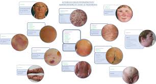 Emerging Treatments In Covid 19 Adverse Drug Reactions Including Drug Hypersensitivities Journal Of Allergy And Clinical Immunology
