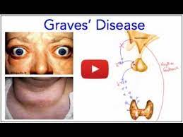 Farwell, md, chief, section of endocrinology, diabetes and nutrition, director basedow disease. Graves Disease Hyperthyroidism Everything You Need To Know Made Easy Youtube