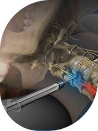 Image result for Lower Cervical Intramuscular Injection