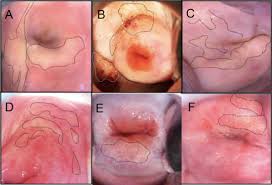 Image result for Colposcopy Findings