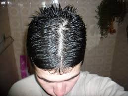 Diffuse hair loss can affect both sexes at any age. Diffuse Thinning 19yo Hairlosstalk Forums