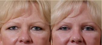 Some of our products are designed by and manufactured by us; Redefinitionlift Vs Lifestyle Lift Belred Cosmetic Surgery