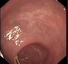 Image result for Microscopic Colitis