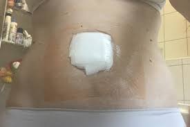 In einigen fällen müssen ärzte eine nabelhernie jedoch operieren. Nabelbruch Op Och No Da Hab Ich Doch Keine Zeit Fur Lacheln Und Winken