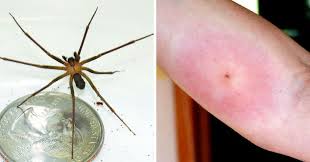 12 Common Bug Bites And How To Recognize Each One In 2020 Bug Bites Spider Bites Insect Bites