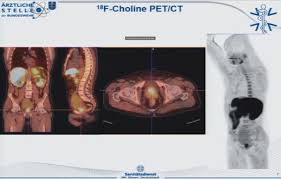 A pet scan is an imaging exam performed to localize metabolic activity inside the body, which helps in detecting cancer and distinguishing between benign and cancerous tissues. Diagnostic Performance Of 68ga Psma Pet Ct To Detect Significant Prostate Cancer And Comparison With 18f Choline Pet Ct Manuela Hoffmann