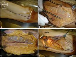 Osteochondritis dissecans (ocd) is an acquired, reversible, idiopathic lesion. Detailed Vascular Anatomy Of The Medial Femoral Condyle And The Significance Of Its Use As A Free Flap Journal Of Plastic Reconstructive Aesthetic Surgery