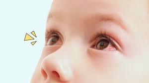 Sudah seminggu ini tidak merah. 5 Penyebab Dan Cara Mengatasi Mata Merah Pada Anak Orami