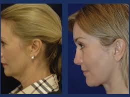Santa Barbara Neck Lift Surgery