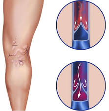 Nabuhshie Veny Prichiny Simptomy I Lechenie Nabuhshih Ven Na Nogah V Moskve