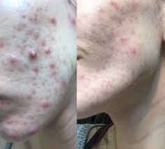 We did not find results for: 20 Most Incredible Before And After Photos Of Redditors And The Routines That Transformed Their Skin Daily Vanity