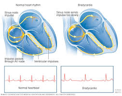 bradycardia symptoms and causes mayo clinic