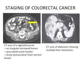 Binderow continues, ct is very good for solid organ disease — liver, spleen, kidneys. Abdominal Ct Scan Colon Cancer Ct Scan Machine