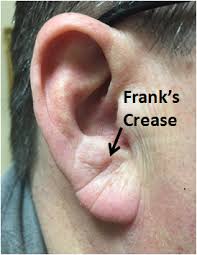 2 oil massage to stop your earlobes hang. Thick Ear Lobes Or A Diagonal Ear Lobe Crease Can Be A Marker For Heart Disease Cardiosound