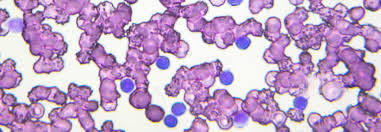 Cll Mehr Als Zwei Drittel Der Patienten Unter Btk Inhibitor Weiterhin Ohne Progress Medical Tribune