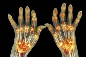 Image result for Rheumatoid Factor