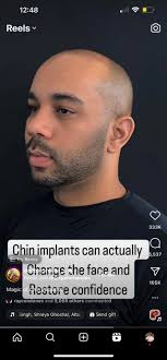 bruce spotted liking a chin implant instagram reel, surgery coming? :  r/BruceDropEmOff