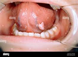 Image result for papillomavirus tongue)