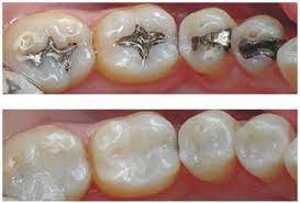 Dental Fillings Are A Common And Widely Used Treatment In Modern Dentistry Dental Fillings Are Used To Fill C Dental Fillings Emergency Dentist Dental Tourism