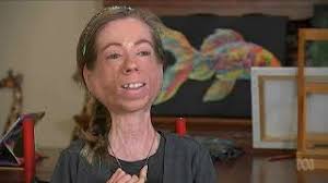 Raising awareness for Myositis amongst GPs and Allied Health works.