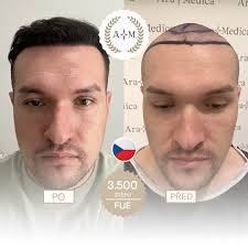 Vážení přátelé, Na fotografiích níže vidíte 11 spokojených klientů  Aratravel, kteří se po úspěšné transplantaci vlasů cítí mnohem sebevědoměji  a spokojeněji s vlastním vzhledem. Naše klinika používá nejmodernější  technologie a metody, aby