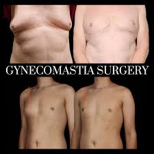 Image result for Gynecomastia