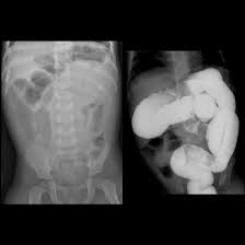 Image result for Intestinal Obstruction