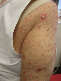 Image result for Generalized Rash
