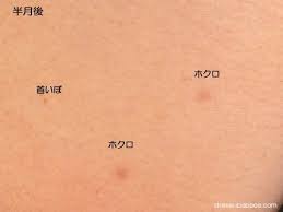 首のいぼ 老人性イボ 除去して取る 半年後 ほくろ除去クリーム イボ 除去 イボ