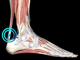 This damage occurs in the spot where your tendon meets your heel bone. Insertional Achilles Tendinopathy Ems Pain Therapy