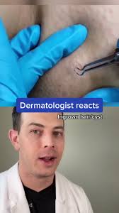 #duet with @ericaspeach yes, it could come back #ingrownhair #pimplepopping  #cystpopping #dermatologistreacts