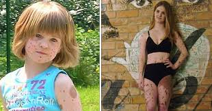Vodafone, double mint chewing gum etc. Girl Born With Spots Everywhere Bullied For Years Becomes Model