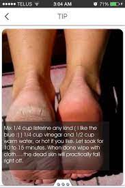 How To Get Rid Of Dry Rough Skin On Your Feet Beauty Remedies Skin Remedies Feet Treatment