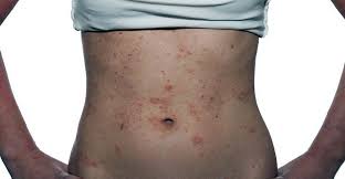 Il 20% circa di questi presenta anche una snas. Diagnosi E Cura Dell Allergia Al Nichel E Snas