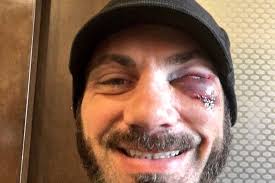 Austin Aries injury update: NXT star reportedly set to undergo surgery