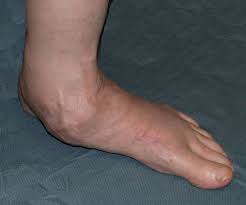 Pin On Oh My Aching Feet
