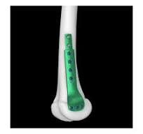 3.5mm Pediatric Femoral Sliding Locking Plate,Medical Device ...