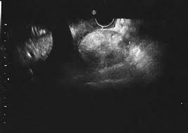 The transvaginal ultrasound images show a small complex ovarian cyst with wall vascularity on power doppler analysis. Ultrasound Sonography Of Metastatic Ovarian Tumor The Vaginal Download Scientific Diagram