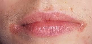заеды в уголках рта причины и лечение у взрослых Zaeda V Ugolke Rta Prichiny I Lechenie Chem Lechit Esli Dolgo Ne Prohodit I Po Kakoj Prichine Poyavlyaetsya Angulyarnyj Hejlit Mozhno Li Ego Predotvratit