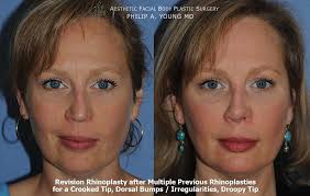 Revision Rhinoplasty After Multiple Previous Rhinoplasties The Patient Was Told That She Couldn T Get Rhinoplasty Body Plastic Surgery Facial Plastic Surgery