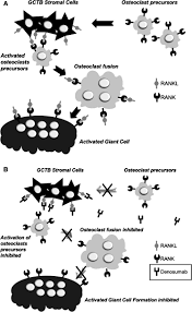 Mehr infos mehr infos (0) jörn langefeld. Giant Cell Tumour Of Bone New Treatments In Development Abstract Europe Pmc